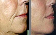 MESOLIFTING FACIAL