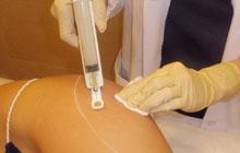 MESOTERAPIA